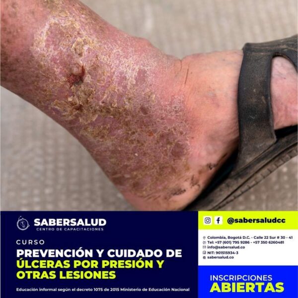 PREVENCIÓN Y CUIDADO DE ÚLCERAS POR PRESIÓN Y OTRAS LESIONES